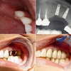 Chi phí trồng răng hàm số 6 bằng phương pháp trồng răng Implant hết bao nhiêu?