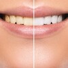 4 Forms Of Teeth Whitening Products