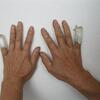 両手小指の第一関節附近の腫れと痛み、更に巻きつめ