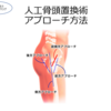 人工骨頭置換術は前側方アプローチが主流