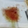 膀胱に腫瘍らしきものがありました（涙）