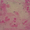S.pneumoniae肺炎(おそらく)