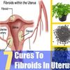 HOW A WOMEN NATURALLY CURE FIBROIDS