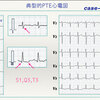 ECG-375：呼吸不全の症例 case-A  answer