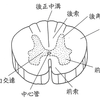 脊髄空洞症の病態生理