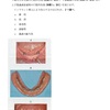 115回歯科医師国家試験【115A-083】義歯　ピエゾグラフィ編