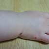 １歳５ヶ月　娘が手足口病になりました