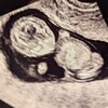 11w2d検診と妊娠糖尿病疑い