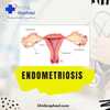 Causes, Symptoms and Treatment of Endometriosis