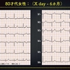 ECG-217：80才代女性。徐脈と血圧低下です。