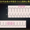 ECG-239：answer