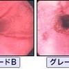 LESとGERD、Sliding Hernia