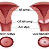 Bệnh ung thư cổ tử cung có nguy hiểm không