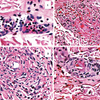 【まとめ】皮膚白血球破砕性血管炎(Cutaneous Leukocytoclastic vasculitis)→Cutaneous IgM/IgG immune complex vasculitis