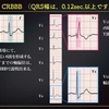 ECG-306：answer