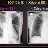 ECG-248：80才代女性。嘔吐と呼吸苦で、搬入でしたが。。