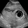 絨毛膜下血腫とは？切迫流産となったら転院が必要？：絨毛膜下血腫(3)