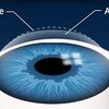 phẫu thuật LASIK của bạn