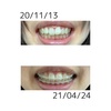 4月の調整日と最近の歯の変化