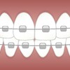 歯列矯正～インビザライン矯正～を始めます