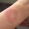 Apple Watchで火傷被害？サポートの6ヶ月迷走と「接触皮膚炎説」で割れる議論の全貌