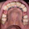 矯正歯科⑧調整1回目