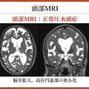 パーキンソン病を科学する３７～正常圧水頭症（NPH）の画像所見とは？｜パーキンソン病との関係も解説