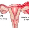 Viêm vòi trứng là như thế nào? nguyên nhân, cách điều trị phù hợp