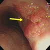 内視鏡検査の大切さについて（食道ガン）