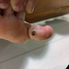 子供の足の指にできたイボの治療経過～治療４、５回目～