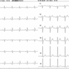 ECG-200：60才代男性。入院時心電図です。