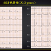 ECG-284：60才代男性。胸部不快感での搬入です。