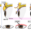 眼瞼下垂の手術同意文書作成中・・・・