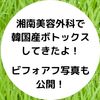 湘南美容外科で韓国産ボトックスをしたので口コミします！オデコ＆アゴの経過写真も！