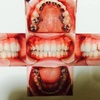 歯列矯正　５ヶ月～写真付き　美白ホームケア