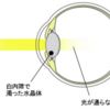 白内障??　55年前から目は悪いが…