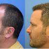 Hair Transplant Phoenix Cost - An Overview