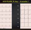 ECG-300：60才代の女性。胸痛と滝のような汗で、ER搬入です。