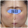【低周波ペンシルでシミを取ってみた！⑫】照射7回目～ダウンタイム中はメイクで隠れるのか？～【経過写真有/シミ取りビフォーアフター】