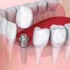 GCC Dental Implants Market Report 2020-2025, Industry Trends, Size, Share, Growth and Outlook