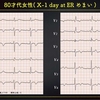 ECG-288：80才代女性。めまいでの受診です。