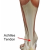 Achilles Tendonitis Treatment And Cause