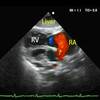 ECG-107：answer