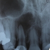 「他院で２年以上治療している、顎が腫れて痛い」～再根管治療で歯を保存できるのか？Re－RCT１年６ケ月リコール