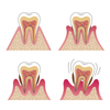 歯周炎とは？
