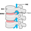 症例報告　右第4・第5腰椎椎間板ヘルニアによる腰痛・左股関節痛
