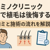 カミノクリニック大阪 提携施術院で植毛は後悔する？口コミと施術の流れを解説！