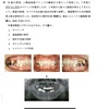 113回　義歯振り返り　即時義歯編