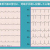 ECG-379：answer-(2/2) 胸部誘導のST上昇 #心電図検定試験　Question-4