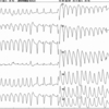 ECG-051：86才女性。突然の失神、入院中の朝。